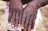 Monkeypox case reported in Delhi