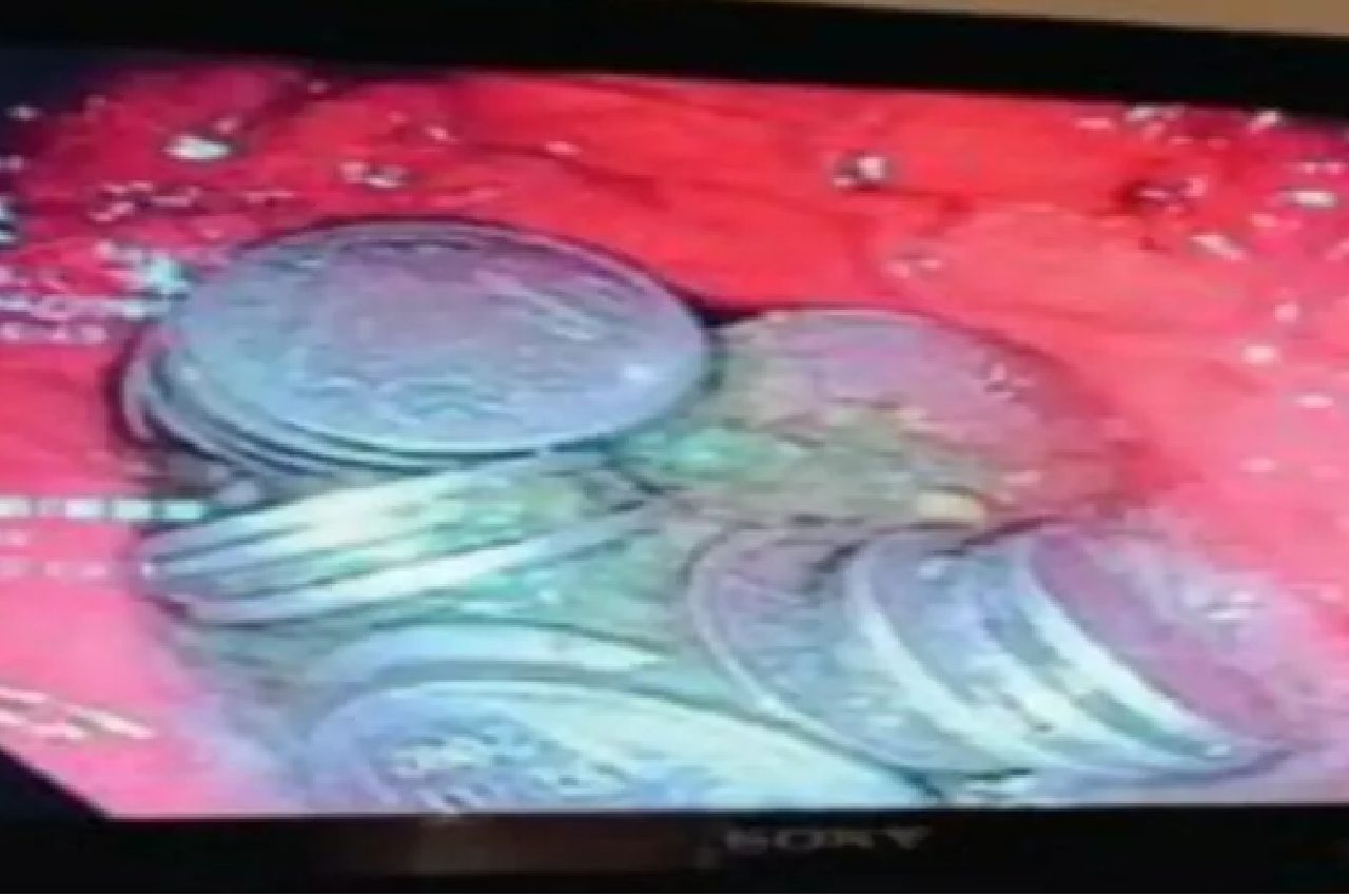 Coins in stomach