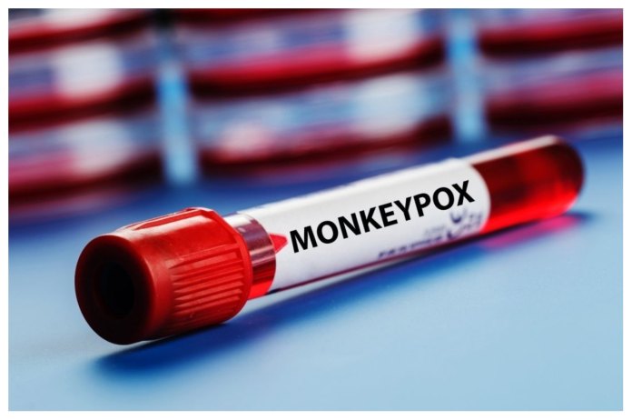 Delhi, monkeypox, India, Nigerian, Kerala, Virus, Monkeypox Virus