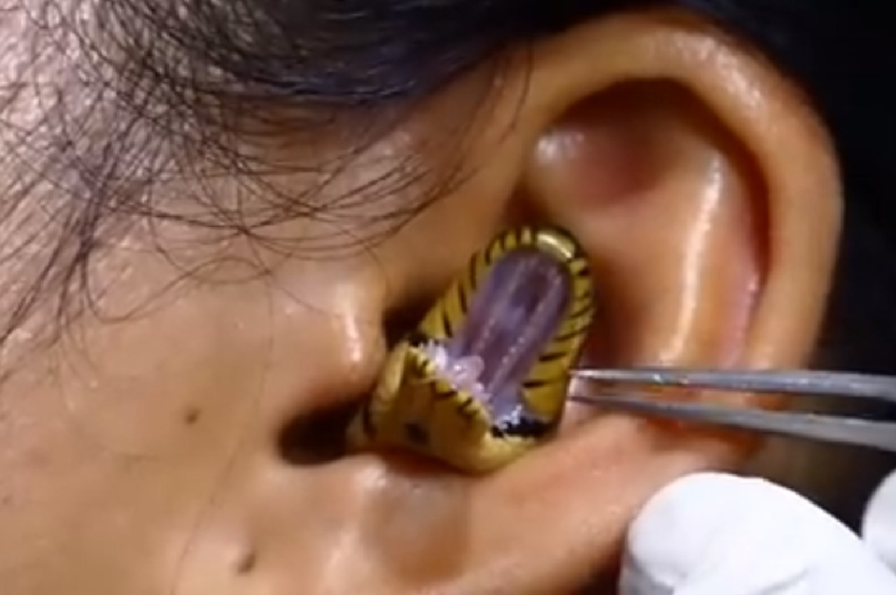 Snake emerges from woman's ear