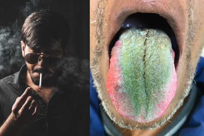 Watch: Man develops green hairy tongue due to smoking addiction