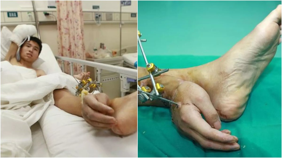 Doctor transplant a man's hand to his ankle in China