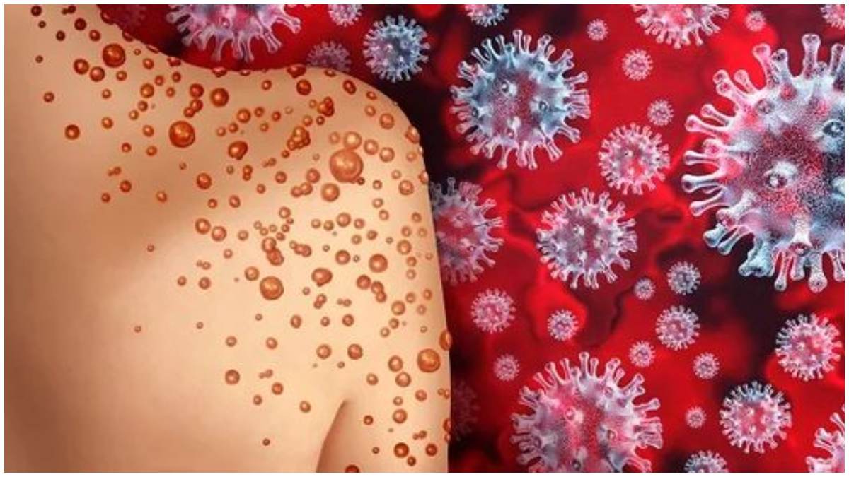 Union Health Ministry of India issued stricter safety measures amid Mpox spread globally