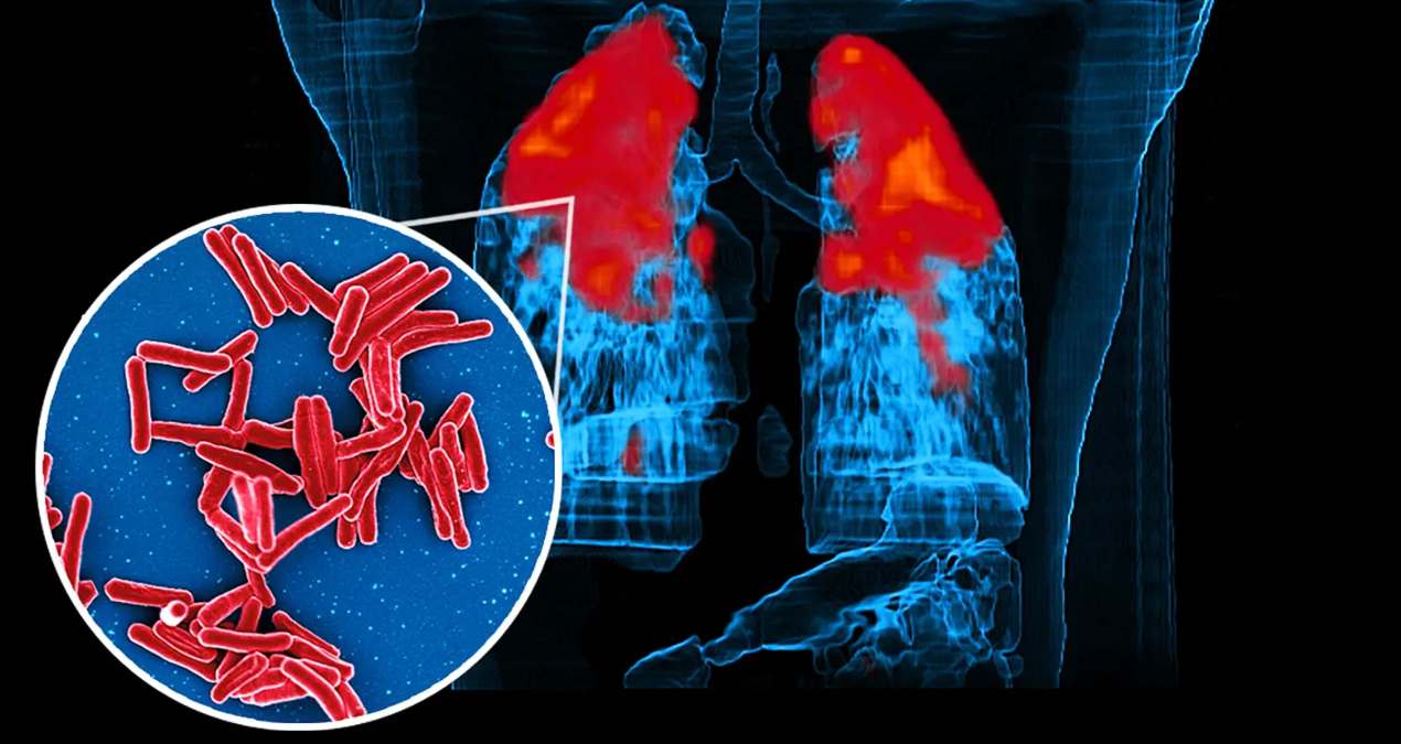 WHO Highlights India’s Tuberculosis Elimination Progress with 18% Decline In Cases