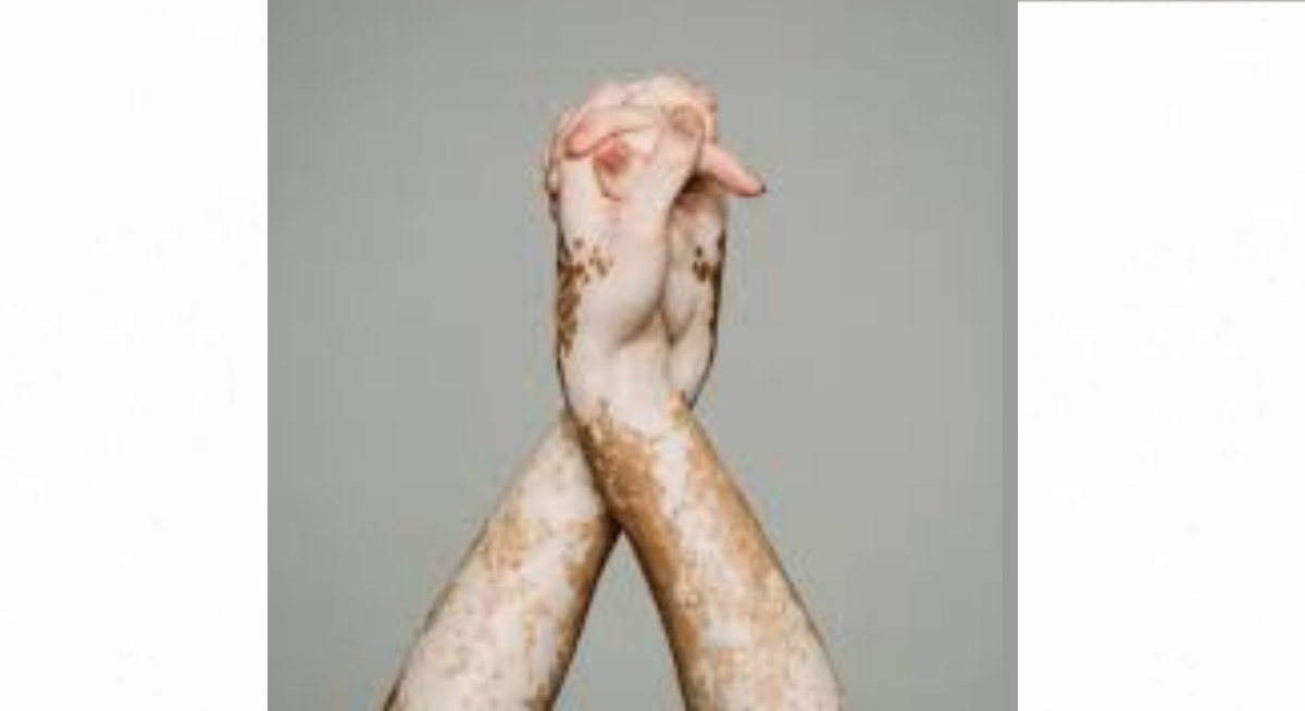 World Vitiligo Day