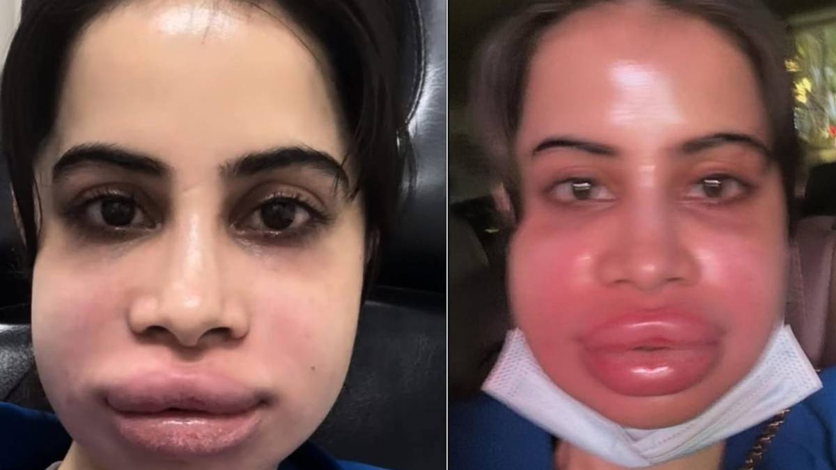 ‘Ducky Bhai’, ‘Ubli Javed’: Uorfi Javed’s Swollen Face After Lip Filler Dissolving Triggers Meme Storm On X