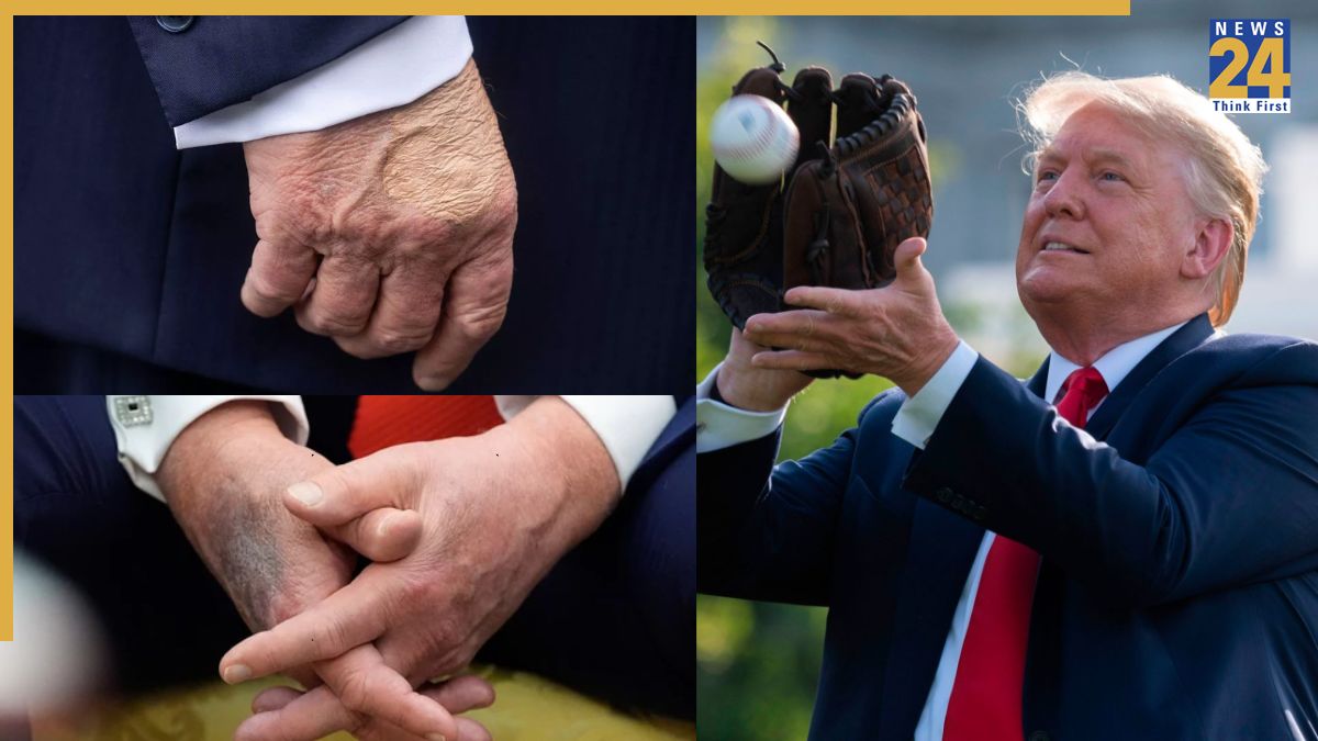 What Happened To Trump? Camera Eyes Clicks Bluish Bruise On US President's Hands! Western Media Says His Health 'Not Okay'