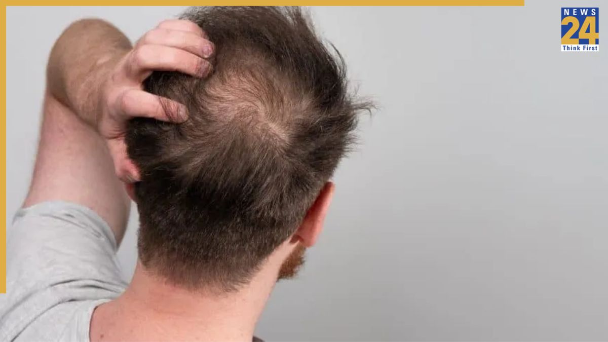 Hair fall Struggling with hair loss? Acharya Balkrishna shares ayurvedic tips for healthy hair growth